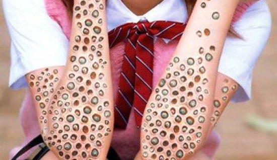 Tripofobi (Delik Korkusu) Nedir?